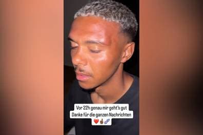 Wegen Bayern-Trikot! Profi zeigt Verletzungen nach Fan-Attacke